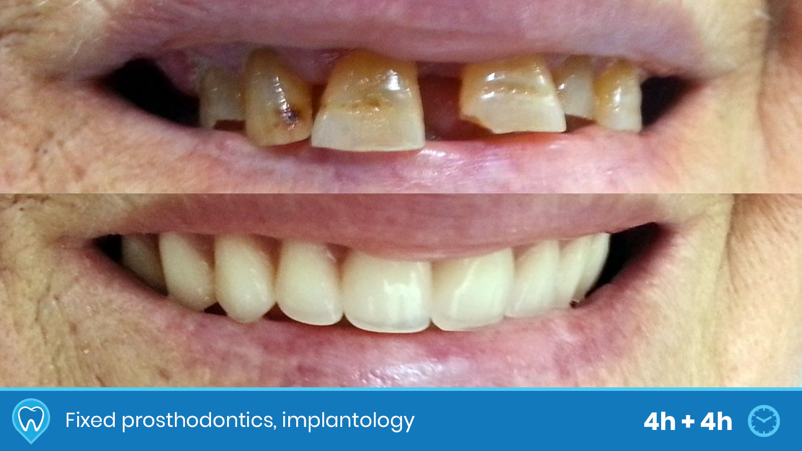 Dental work examples BeforeAfter Dental Tourist