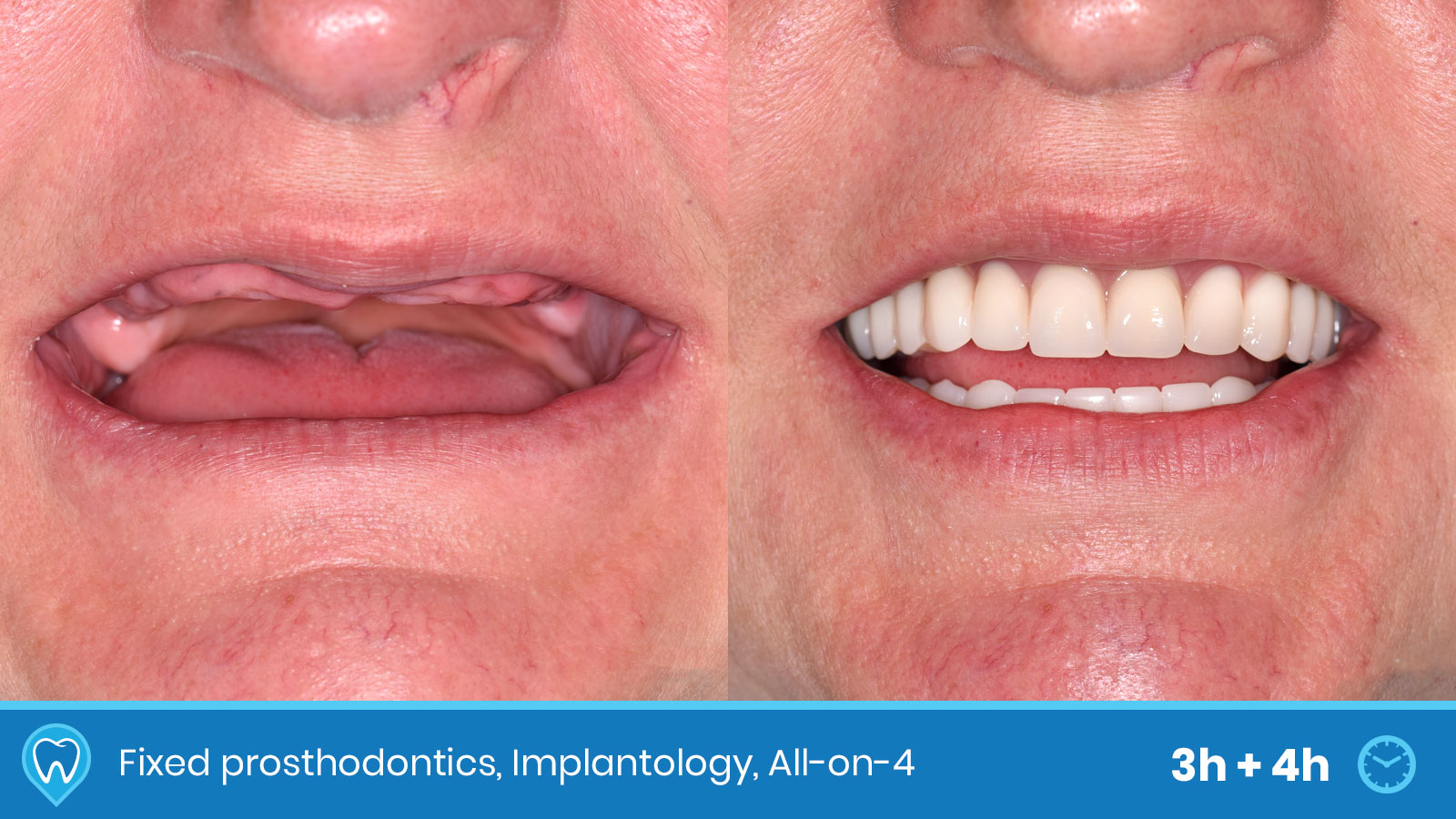 Dental work examples BeforeAfter Dental Tourist